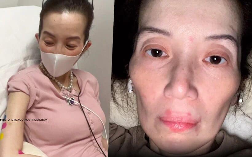 kris-aquino-health-status-820